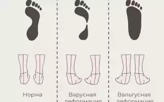 В чем заключается причина, диагностика и методы лечения варусных стоп у детей?