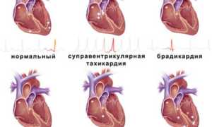 Что такое тахикардия сердца и как она проявляется