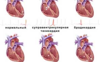 Что такое тахикардия сердца и как она проявляется