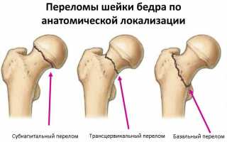 Возможные причины, лечение и меры профилактики перелома шейки бедра у пожилых людей