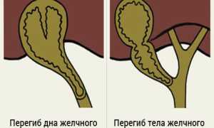 Симптомы и лечение перегиба желчного пузыря у ребенка