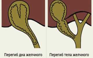 Симптомы и лечение перегиба желчного пузыря у ребенка