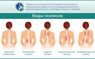 Симптомы, причины и методы лечения сколиоза грудного отдела позвоночника: полное и подробное руководство по коррекции