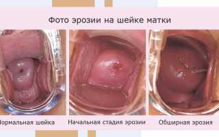 Возможные последствия прижигания эрозии шейки матки – обильные выделения и их причины