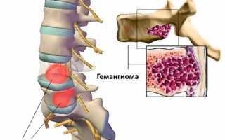 Нужна ли операция для лечения гемангиомы на позвоночнике?