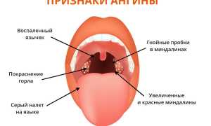 Что такое ангина и чем она опасна