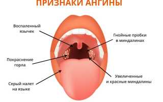 Что такое ангина и чем она опасна