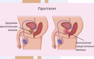 Как распознать и лечить хронический простатит, который проявляется латентным течением