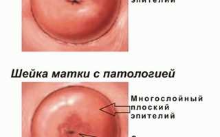 Причины, симптомы и лечение сукровицы из влагалища
