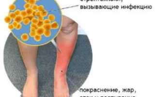 Рожистое воспаление ноги – лечение: народные средства в домашних условиях
