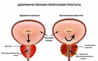 Почему возникает затрудненное мочеиспускание у мужчин и как его лечить