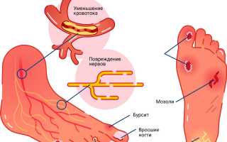 Лечение диабетической ангиопатии нижних конечностей