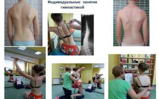 Эффективные упражнения по методу Катарины Шрот для лечения сколиоза through gymnastics
