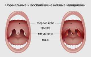 Как определить и лечить гнойную ангину у беременных и как ее предотвратить