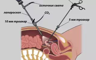Что такое адгезиолизис и как предотвратить его возникновение