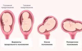 Что такое продольное положение плода во время беременности и как оно может повлиять на процесс развития ребенка?