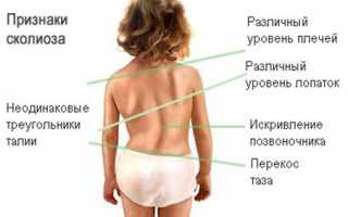 Причины, симптомы, методы лечения и профилактика сколиоза 3 степени