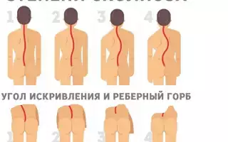 Значение и влияние S-образного изгиба позвоночника человека: причины, последствия и возможные последствия