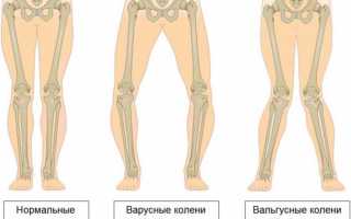 Причины, симптомы и методы лечения варусной деформации коленных суставов.