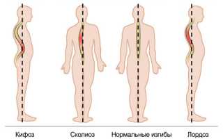 Причины, симптомы и методы лечения деформаций позвоночника: кифоза, лордоза, сколиоза и спондилолистеза.
