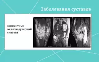 Пигментный виллонодулярный синовит: симптомы, причины и эффективные методы лечения