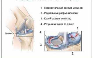 Вред мениска: причины, симптомы и методы лечения