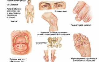 Реактивные артриты: причины, симптомы и эффективные методы лечения