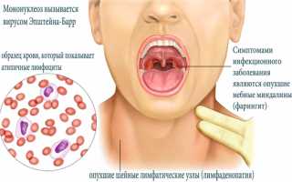 Причины, симптомы и лечение инфекционного мононуклеоза у детей