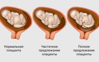 Причины и решения – что делать, если плацента перекрывает внутренний зев?