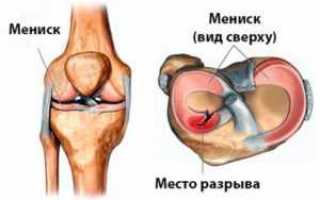 Можно ли получить страховку при разрыве внутреннего мениска