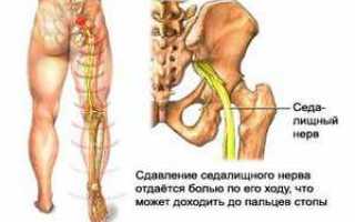 Защемление нерва в крестце: симптомы, первая помощь, лечение и последствия