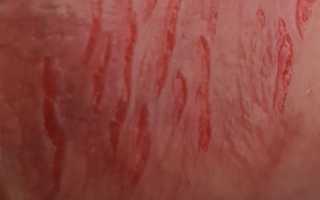 Как можно эффективно лечить трещины на крайней плоти у мужчин?