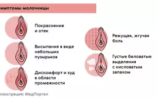 Молочница: симптомы, лечение и рекомендации в ранние сроки беременности
