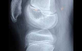 Симптомы, диагностика и лечение Patella bipartita: особенности и проблемы удвоения надколенника
