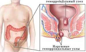 Что такое геморрой и как он проявляется