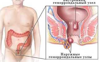 Что такое геморрой и как он проявляется