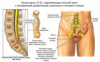 Грыжа в спине: как распознать симптомы и признаки научно-медицинского портала