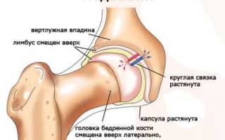 Вывих бедра у новорожденных