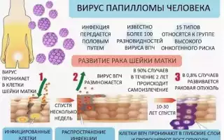 Выбор и схемы лечения женщин с ВПЧ – эффективные препараты и методы терапии