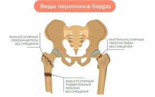Какие обезболивающие средства и методы помогают при переломе шейки бедра и снижают боль?