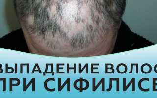Причины и методы лечения выпадения волос при сифилисе