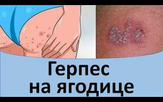 Симптомы и лечение герпеса на ягодицах