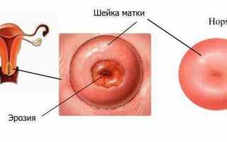Проблемы, симптомы и методы лечения вывода шейки матки