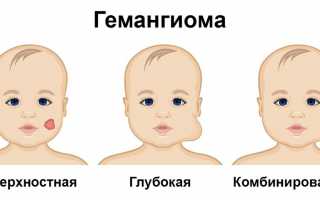 Симптомы, причины и лечение гемангиомы у детей: полное руководство