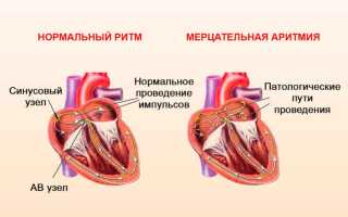 Что такое аритмия сердца и как с ней жить