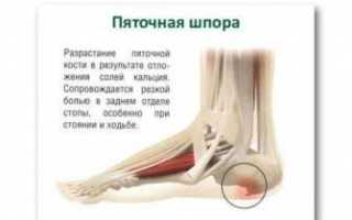 Как избавиться от шпоры в пятке быстро и без последствий