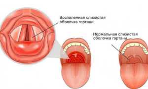 Что такое ларингит и чем он опасен