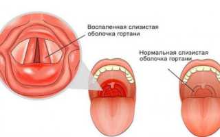 Что такое ларингит и чем он опасен