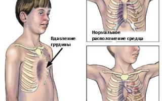 Развитие грудной клетки: варианты, факторы и возможности коррекции