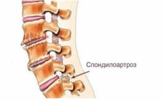 Спондилоартроз: симптомы, причины и эффективные методы лечения